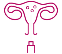 IVF